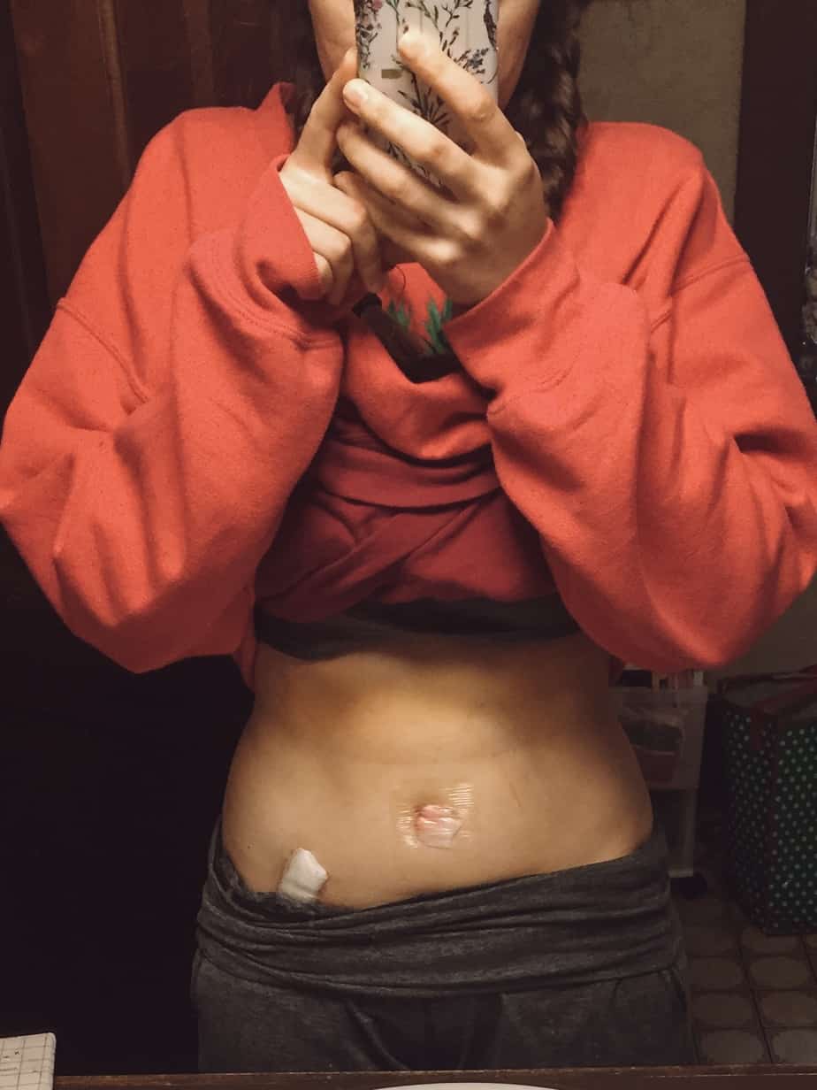 Many doctors aren't aware that IBS can actually be bowel endometriosis. This is my bowel endometriosis story, and the long journey to a diagnosis. #endometriosis #chronicillness #bowelendometriosis #ibs #health #wellness