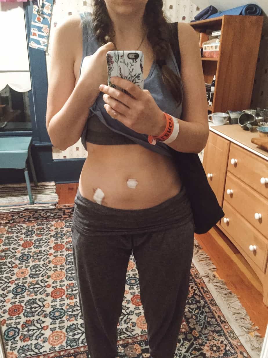 Many doctors aren't aware that IBS can actually be bowel endometriosis. This is my bowel endometriosis story, and the long journey to a diagnosis. #endometriosis #chronicillness #bowelendometriosis #ibs #health #wellness